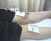 膝关节温针灸示意图