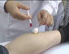 穴位注射操作示意图 