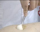 穴位注射操作示意图 